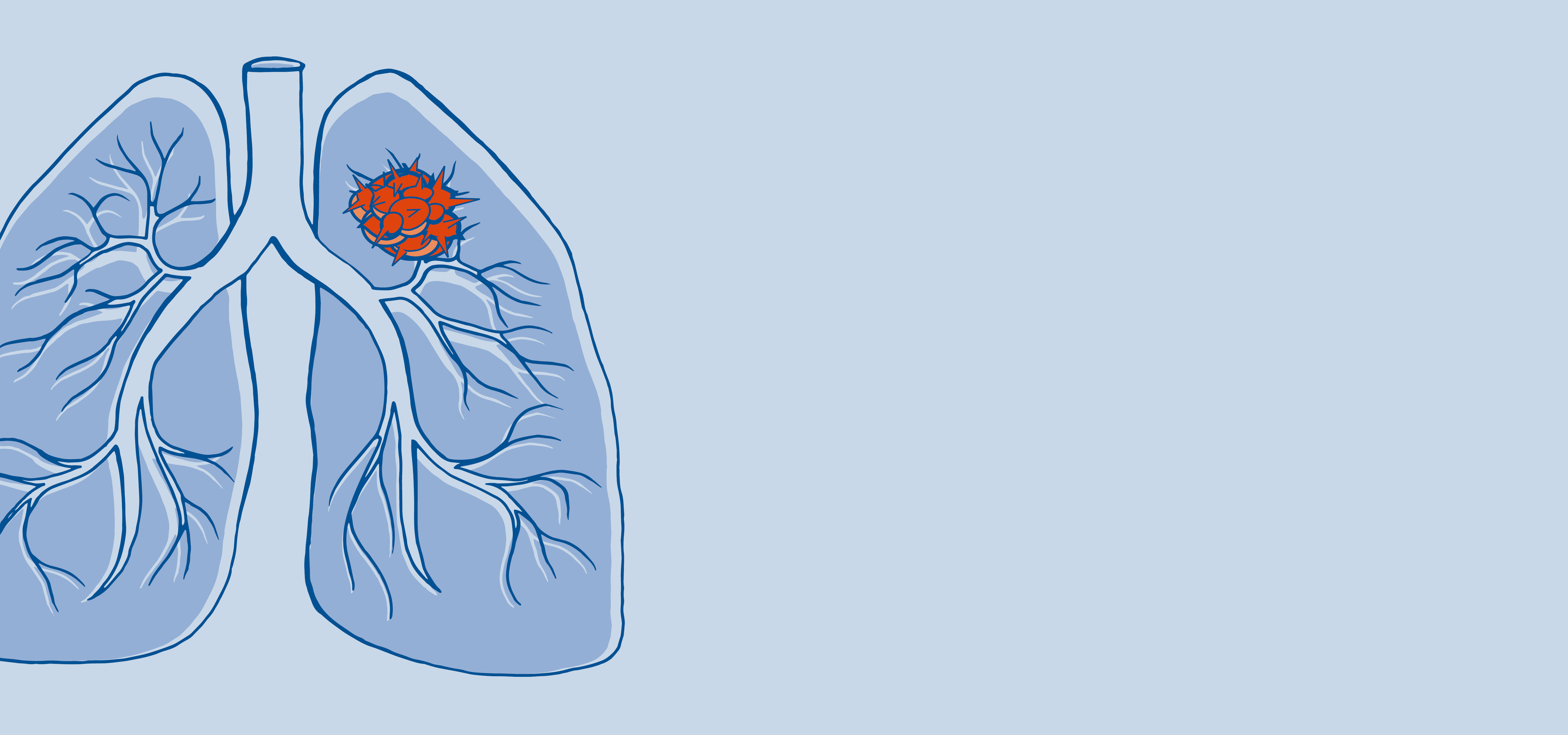  Schematische Zeichnung einer Lunge mit Krebszelle