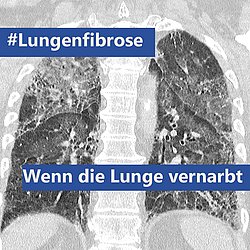2021_07_Lungenfibrose.jpg